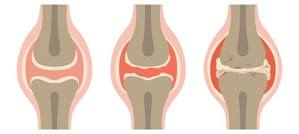 Příznaky osteoartritidy
